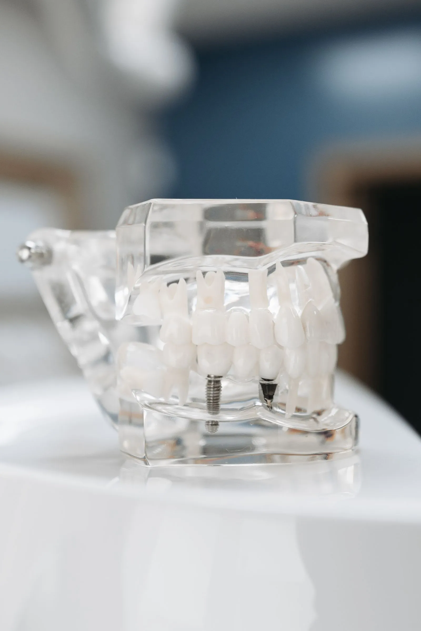 Modelo dental mostrando un implante de titanio junto a piezas naturales (Clínica Dentalcom)